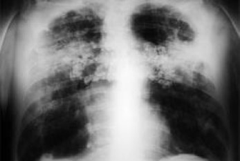 La silicosis encabeza la lista de enfermedades respiratorias de origen laboral en países en desarrollo